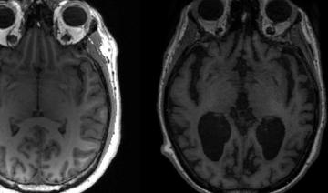 La cause de la progression de la maladie d'Alzheimer dans le cerveau découverte